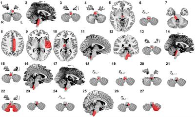 Lesions causing central sleep apnea localize to one common brain network